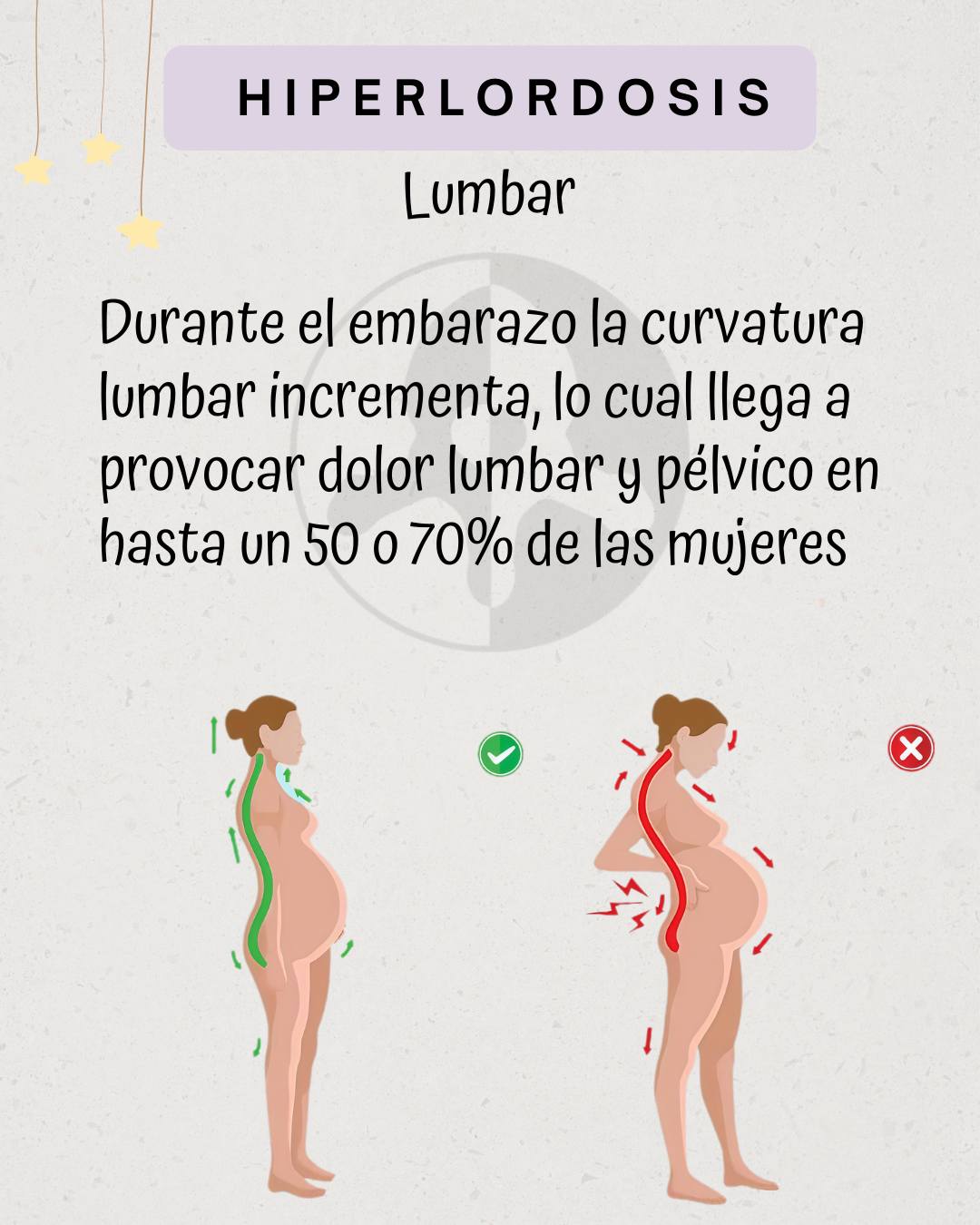 Hiperlordosis lumbar
